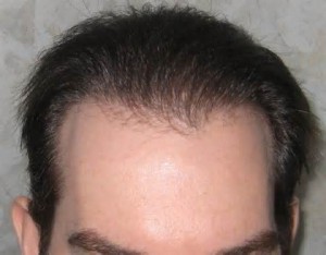 пересадка волос на голове