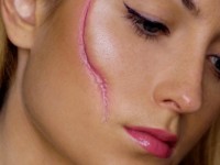 Удаление рубцов и шрамов: цена различных способов возвращения красоты и эластичности кожи