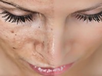 Удаление пигментных пятен на лице, теле с помощью методов современной косметологии