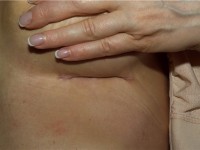 шрамы после увеличения груди