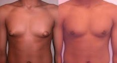 Операция по восстановлению формы груди при гинекомастии