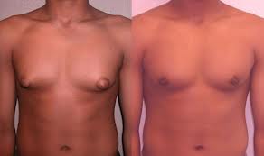 Операция по восстановлению формы груди при гинекомастии