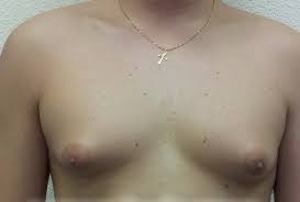 Гинекомастия – заболевание доброкачественного характера, проявляющееся увеличением грудных желез у мужчин. Классифицируется на истинную и ложную. Истинная гинекомастия у мужчин вызвана разрастанием железистых тканей молочной железы