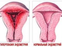 Причины эндометриальной гиперплазии