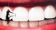 Простое и глубокое фторирование зубов