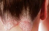 Лечение себореи на коже головы