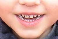 Серебрение зубов у детей: все за и против