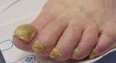 Заболевания ногтей на ногах