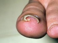 Частые болезни ногтей на ногах