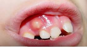 Как лечат кисту зуба?