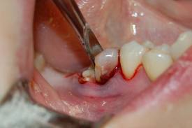 Как удаляют кисту зуба?