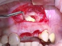 Как удаляют кисту зуба без хирургического вмешательства? 