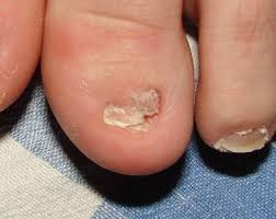 Гелевое протезирование ногтей на ногах