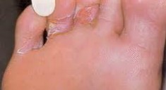 Как лечат трещины между пальцами ног?