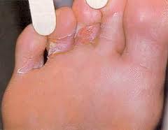 Как лечат трещины между пальцами ног?