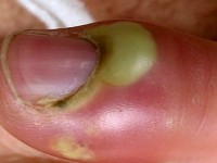 Воспаление ногтя большого пальца ноги