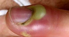 Воспаление ногтя большого пальца ноги