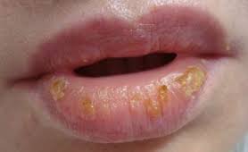 Хейлит на губах: виды заболевания