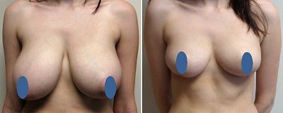 Методы уменьшения груди