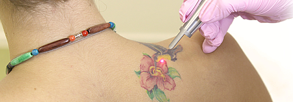 Процедура удаления татуировок с помощью Q-switch Nd:YAG – лазера