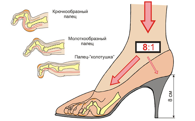 Лечение плоскостопия