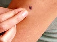 Ученые рассказали, как летом избежать рака кожи