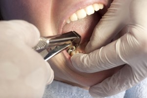 Особенности операции по удалению зуба мудрости